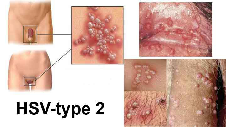 Tìm hiểu tổng quan về chứng bệnh Herpes sinh dục-4