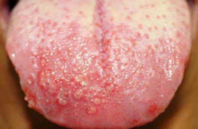 Tìm hiểu tổng quan về chứng bệnh Herpes sinh dục-7