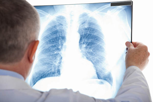 chẩn đoán nấm phổi