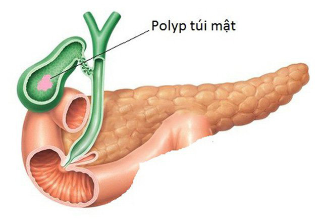 Hình ảnh Polyp túi mật