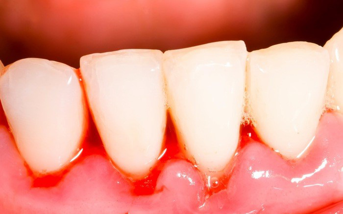 Chảy máu chân răng Nguyên nhân, dấu hiệu và cách phòng ngừa-1