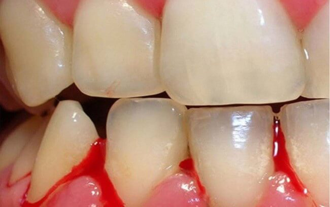 Chảy máu chân răng Nguyên nhân, dấu hiệu và cách phòng ngừa-4