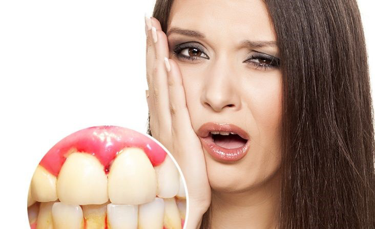 Chảy máu chân răng Nguyên nhân, dấu hiệu và cách phòng ngừa-5
