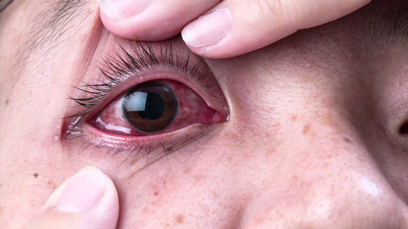 Tổng quan về bệnh đau mắt đỏ là gì Nguyên nhân, dấu hiệu và cách điều trị 2