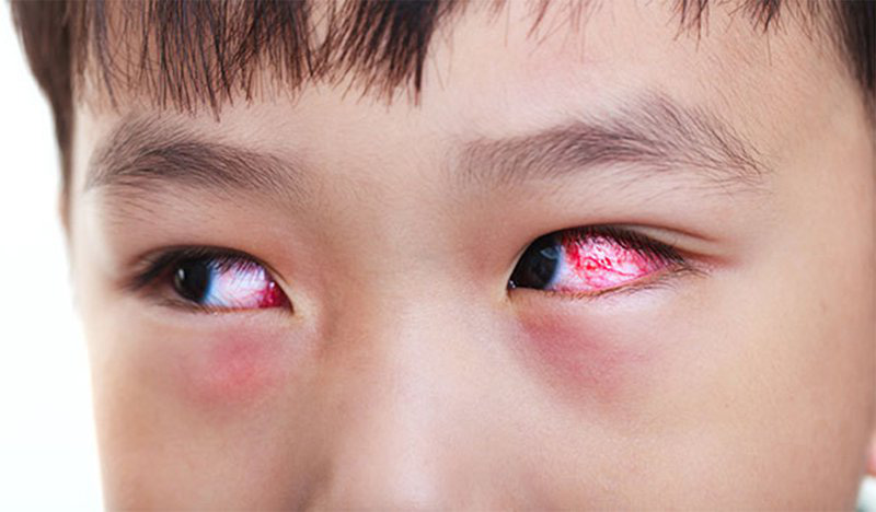 Tổng quan về bệnh đau mắt đỏ là gì Nguyên nhân, dấu hiệu và cách điều trị3
