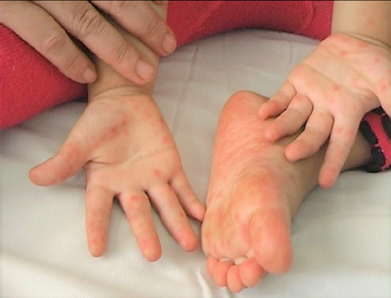 Bệnh tay chân miệng là gì Những thông tin cần biết về bệnh tay chân miệng 2