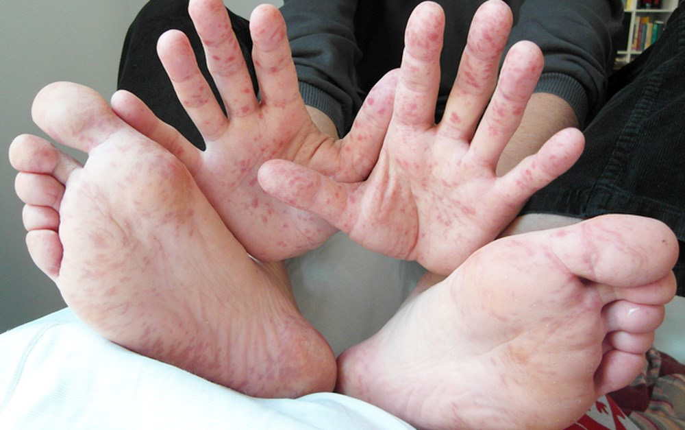 Bệnh tay chân miệng là gì Những thông tin cần biết về bệnh tay chân miệng 3