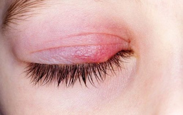 Có những biện pháp nào để giảm triệu chứng và mục tiêu điều trị lẹo mắt?
