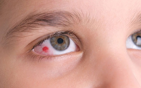 Xuất huyết dưới kết mạc làm ảnh hưởng đến thị lực không?
