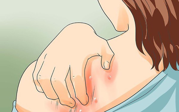 Lá muồng trâu có tác dụng gì trong việc chữa bệnh ghẻ ngứa?
