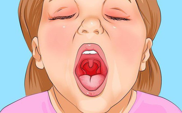 Viêm họng trắng có nguy hiểm không?
