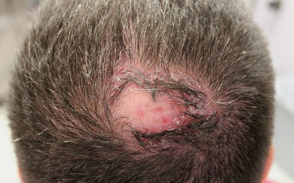 Viêm nang lông da đầu gây rụng tóc: Cách xử lý và phòng ngừa biến chứng
