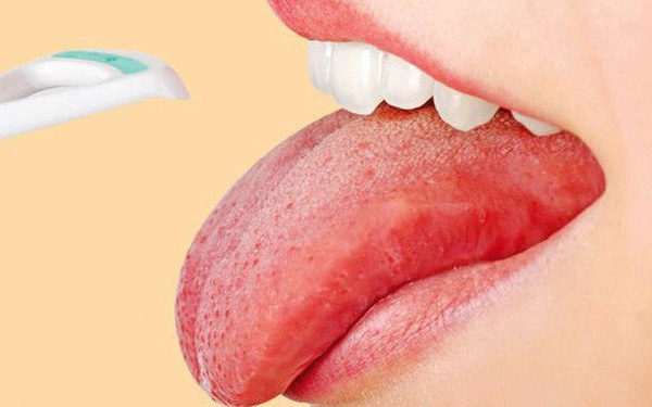 Làm sao để chữa trị rát lưỡi tại nhà?
