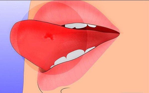 Ung thư lưỡi giai đoạn cuối có triệu chứng như thế nào?
