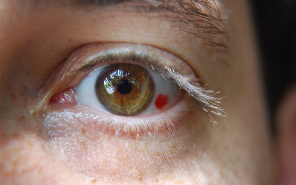 Vỡ mạch máu mắt có thể liên quan đến những bệnh lý gì khác?
