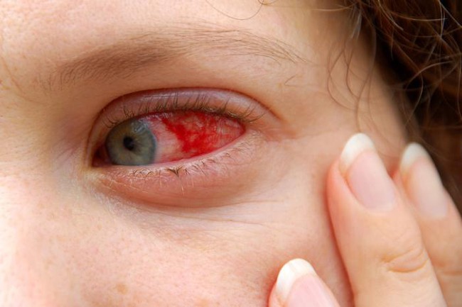 Thuốc nhỏ mắt điều trị viêm kết mạc (đau mắt đỏ): Nên dùng khi nào? Cần lưu ý gì? - Ảnh 4.