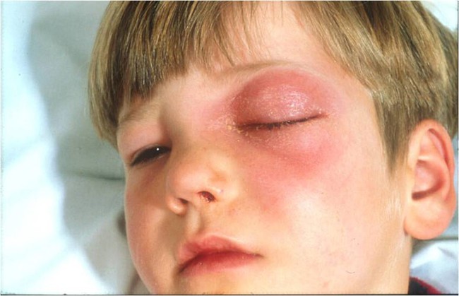Viêm sưng tấy mi mắt là một biến chứng của viêm xoang cấp tính (Ảnh: Internet)