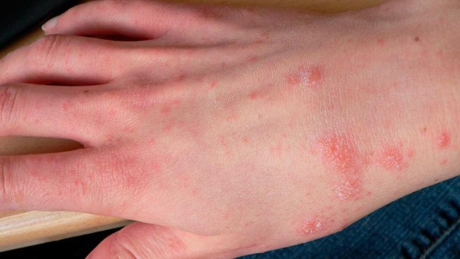 Cẩn trọng với các loại nấm da phổ biến vào mùa mưa - Ảnh 3.