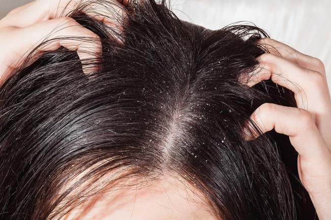 Những điều cần biết về nấm da đầu để phòng tránh hiệu quả - Ảnh 2.