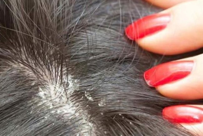 Những điều cần biết về nấm da đầu để phòng tránh hiệu quả - Ảnh 1.