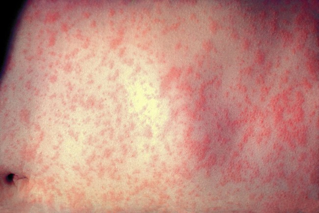 Cách phân biệt bệnh sởi và bệnh sốt phát ban - Ảnh 2.