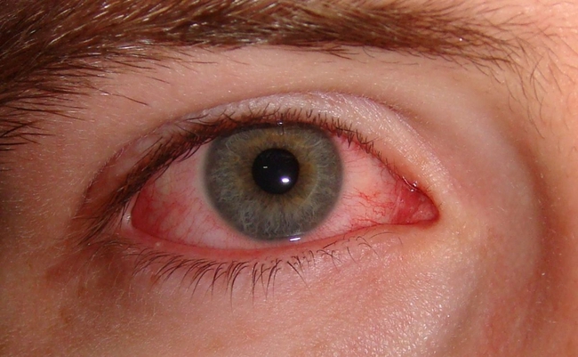 Cẩn thận bị mất thị lực vĩnh viễn nếu bị biến chứng mắt do sởi - Ảnh 2.