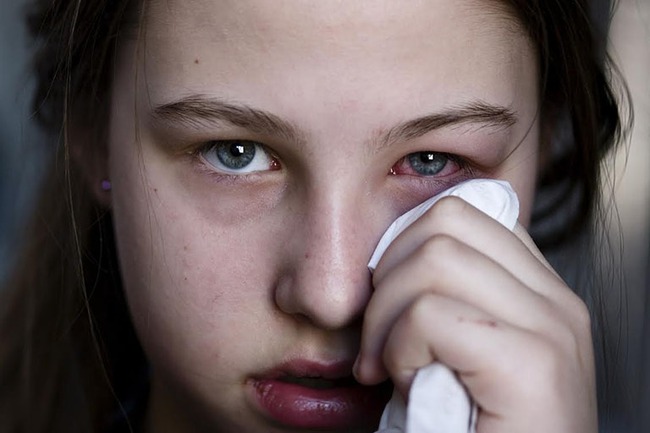 Viêm nhiễm ổ mắt là biến chứng của viêm xoang cấp tính thường gặp ở trẻ em (Ảnh: Internet)