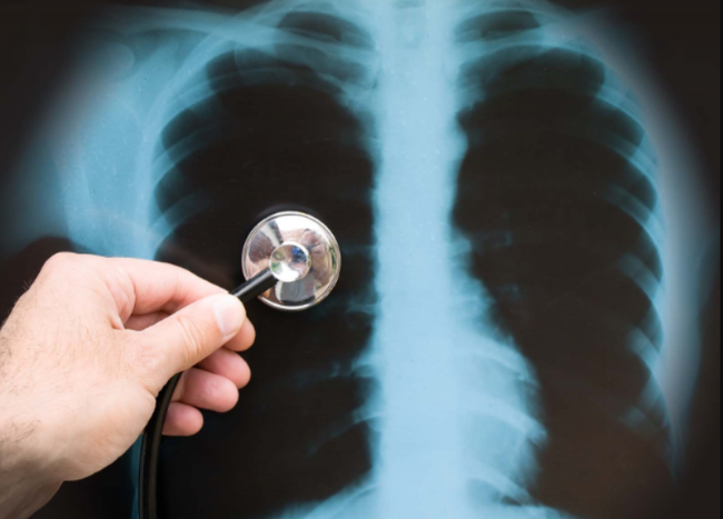 Chụp X quang có thể phát hiện bệnh phổi tắc nghẽn mãn tính không? - Ảnh 3.