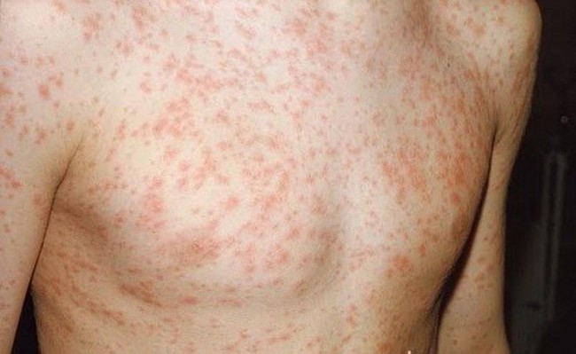 Mọc nhiều nốt đỏ sau sốt cao có thể là dấu hiệu điển hình của bệnh sởi - Ảnh 2.