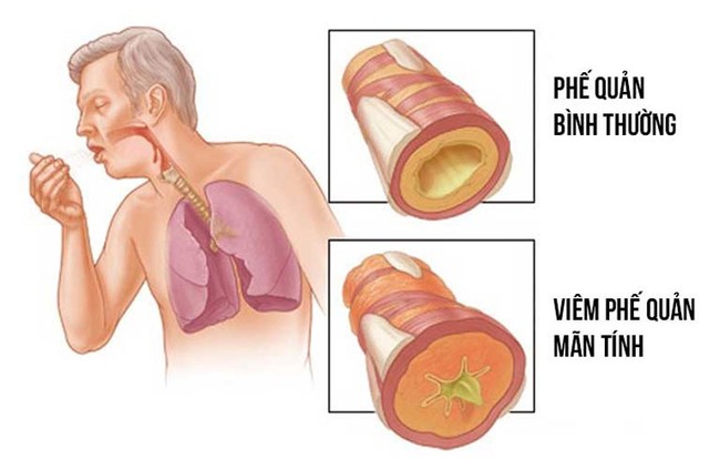 Tại sao COPD gây khó thở? Làm thế nào để kiểm soát khó thở do COPD? - Ảnh 2.