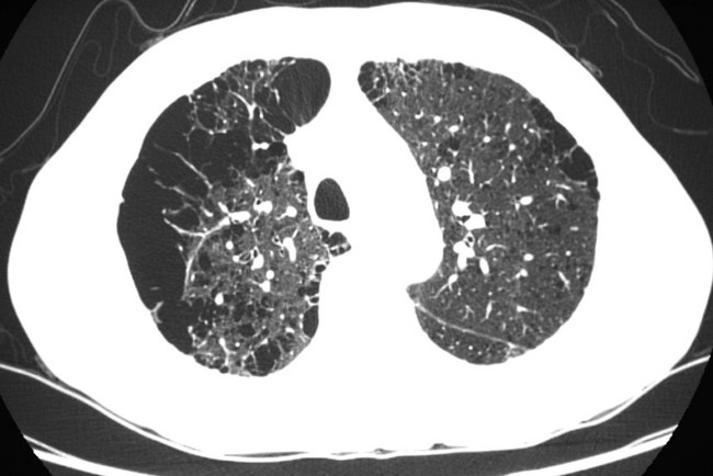 Ứng dụng X-Quang và CT-Scaner trong chẩn đoán COPD - Ảnh 3.