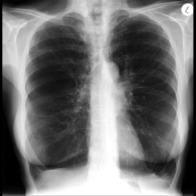 Mối quan hệ giữa nguyên nhân di truyền và bệnh phổi tắc nghẽn mãn tính (COPD) - Ảnh 1.