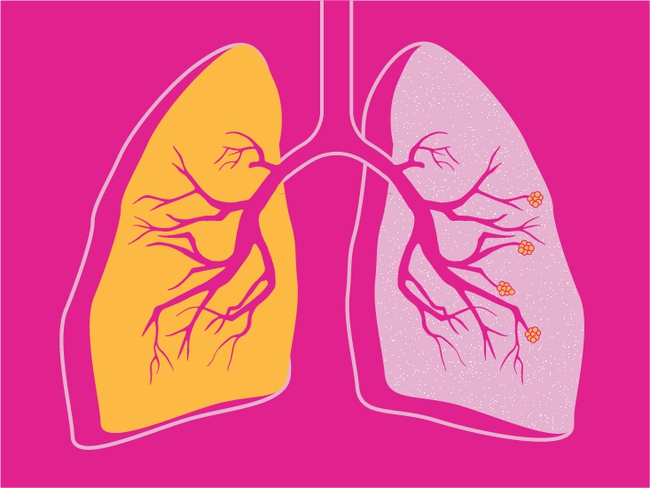 Độ tuổi có thể khởi phát COPD là bao nhiêu? Người trẻ có nguy cơ mắc bệnh hay không? - Ảnh 1.