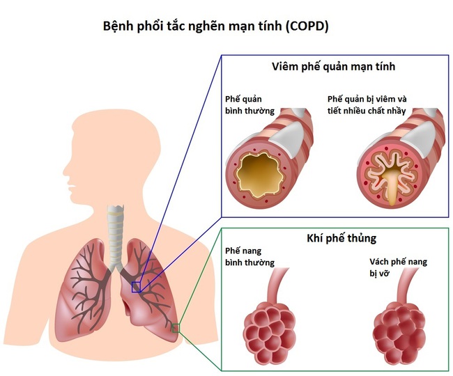 phân biệt COPD và khí phế thũng