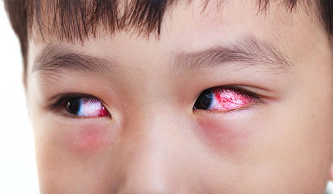 Những điều cần biết về bệnh đau mắt đỏ ở trẻ em - Ảnh 3.