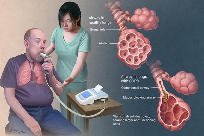 Quản lý COPD ở người cao tuổi: Cải thiện chất lượng cuộc sống thông qua tự kiểm soát - Ảnh 2.