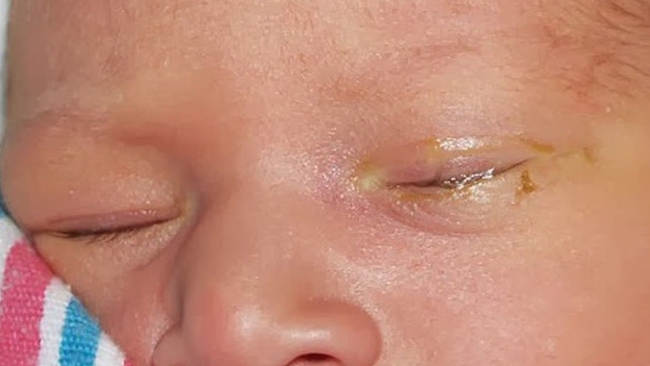 Trẻ sơ sinh bị đau mắt đỏ: nguyên nhân và cách điều trị - Ảnh 4.