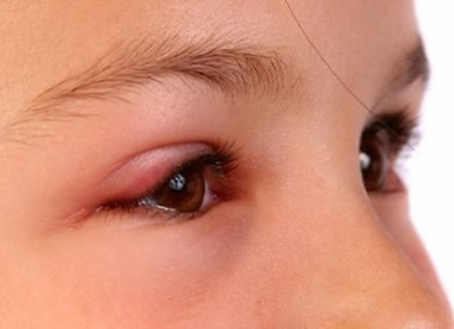 Dấu hiệu của bệnh đau mắt đỏ ở trẻ nhỏ bạn không nên bỏ qua - Ảnh 3.