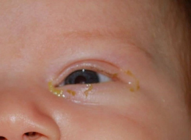 Trẻ sơ sinh bị đau mắt đỏ: nguyên nhân và cách điều trị - Ảnh 3.