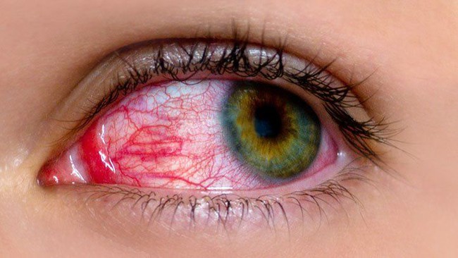 Sai lầm khi chăm sóc người bị đau mắt đỏ khiến tình trạng bệnh trở nên nặng hơn - Ảnh 1.
