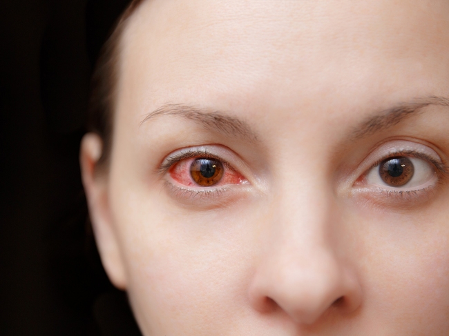 Tổng hợp chung các bệnh dễ nhầm lẫn với đau mắt đỏ - Ảnh 2.