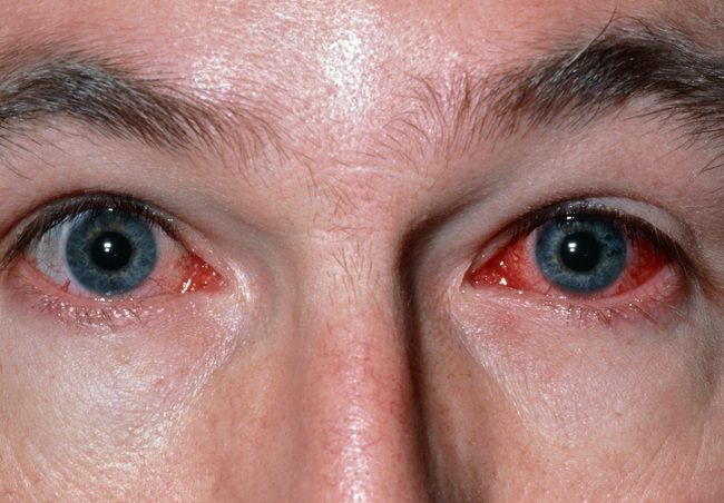Tổng hợp chung các bệnh dễ nhầm lẫn với đau mắt đỏ - Ảnh 1.