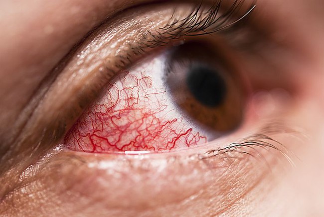 Tổng hợp chung các bệnh dễ nhầm lẫn với đau mắt đỏ - Ảnh 3.