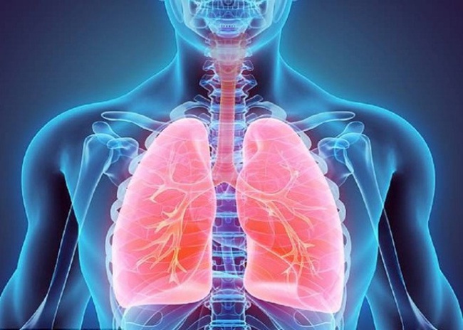 Tràn khí màng phổi: Nguyên nhân, triệu chứng, cách điều trị   - Ảnh 3.