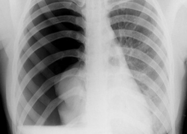 Tràn khí màng phổi: Nguyên nhân, triệu chứng, cách điều trị   - Ảnh 1.
