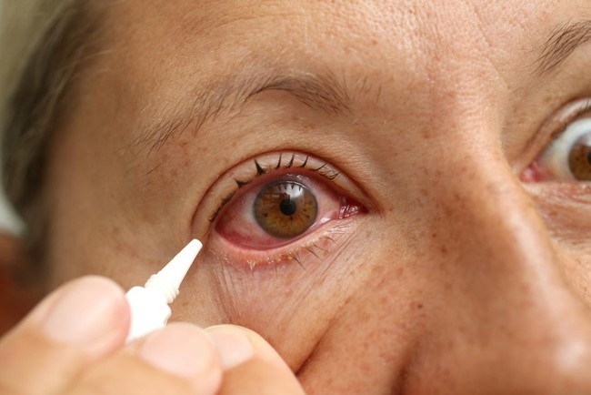 Các biện pháp điều trị đau mắt đỏ tại nhà giúp làm dịu các triệu chứng khó chịu - Ảnh 1.