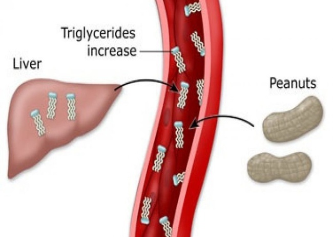 Triglyceride là gì? Biến chứng và cách kiểm soát căn bệnh này - Ảnh 1.