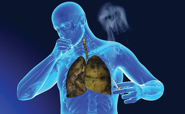 Phân biệt COPD và các bệnh về phổi dễ bị nhầm lẫn - Ảnh 3.