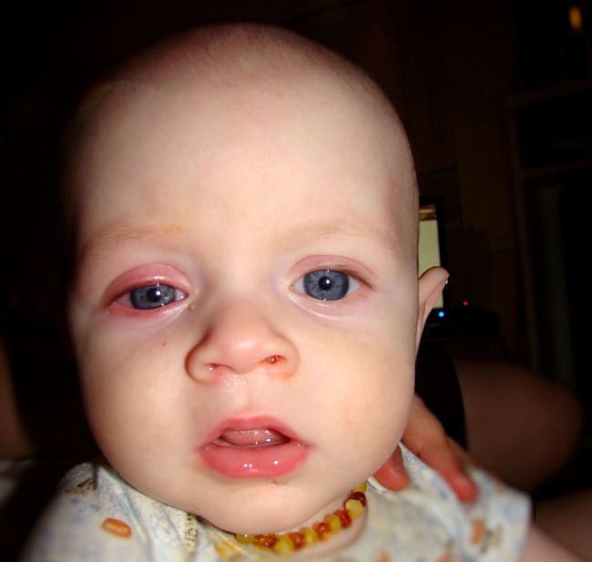 Sưng đỏ ở một hoặc 2 mí mắt là dấu hiệu của bệnh đau mắt đỏ ở trẻ nhỏ (Ảnh: Internet)