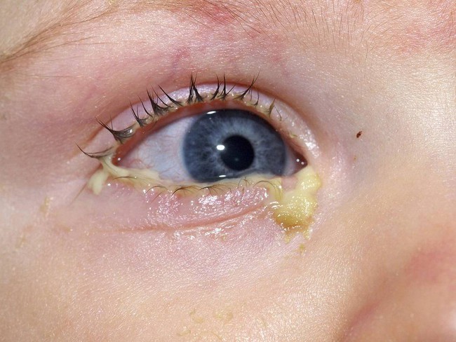 Ghèn nhiều ở mi mắt, có màu vàng hoặc hơi ngả xanh là một triệu chứng của đau mắt đỏ ở trẻ nhỏ (Ảnh: Internet)